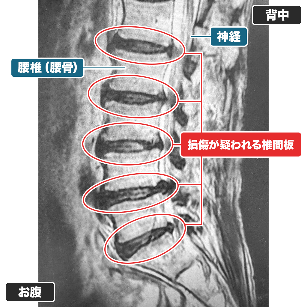 MRI