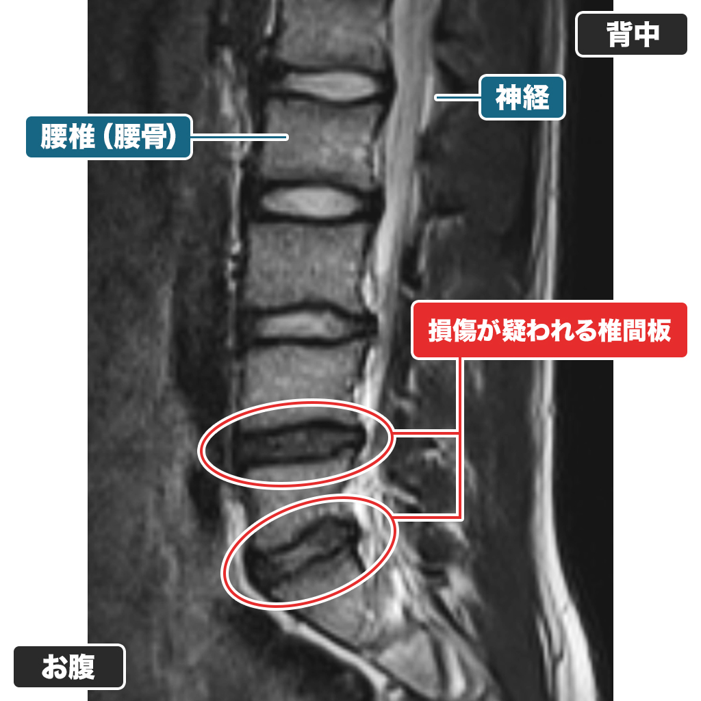 MRI