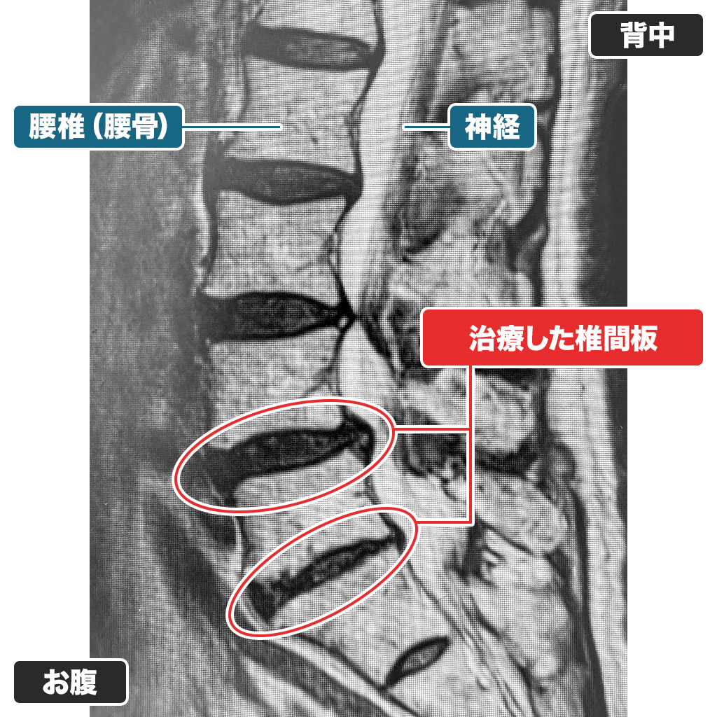 MRI写真(治療後)