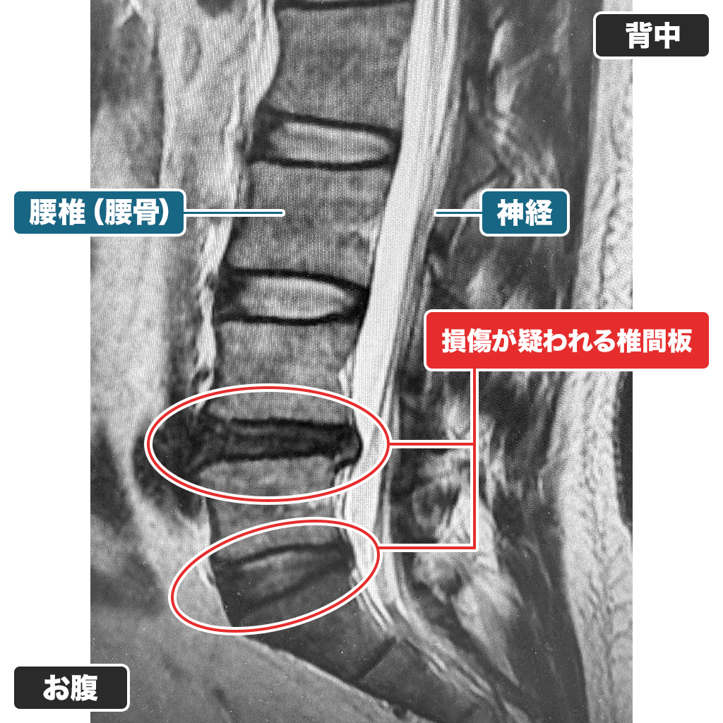 MRI