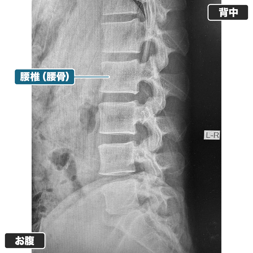 レントゲン