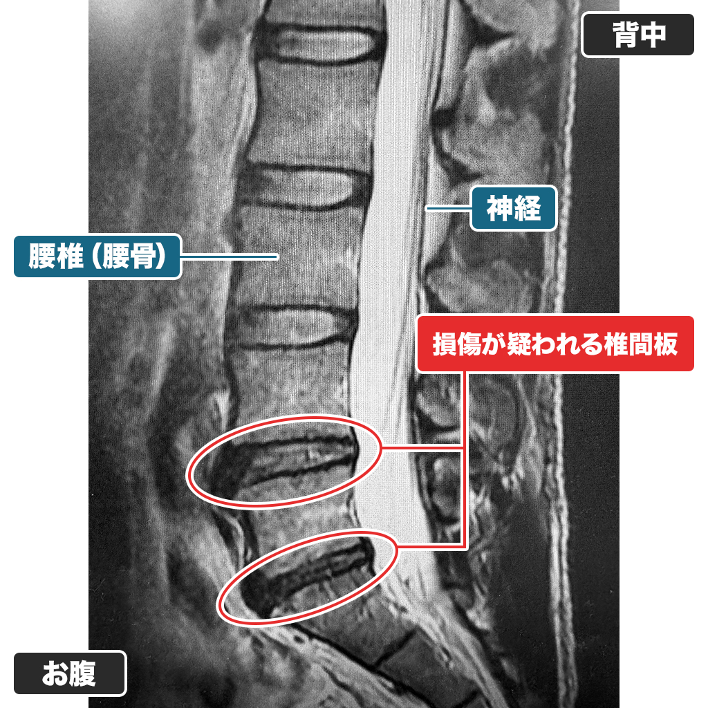MRI