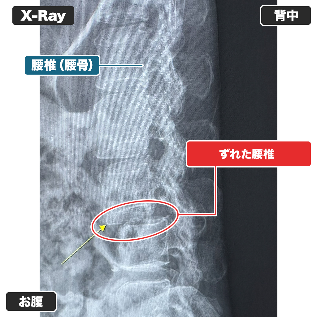 レントゲン