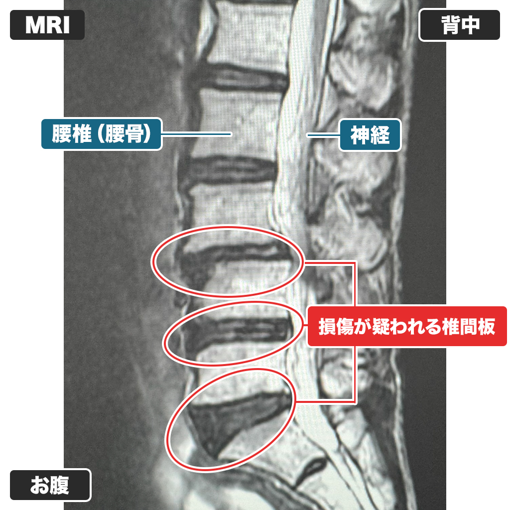 MRI