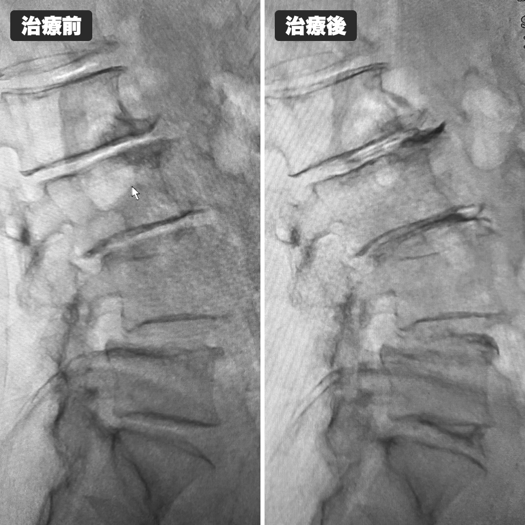 治療前後のレントゲン
