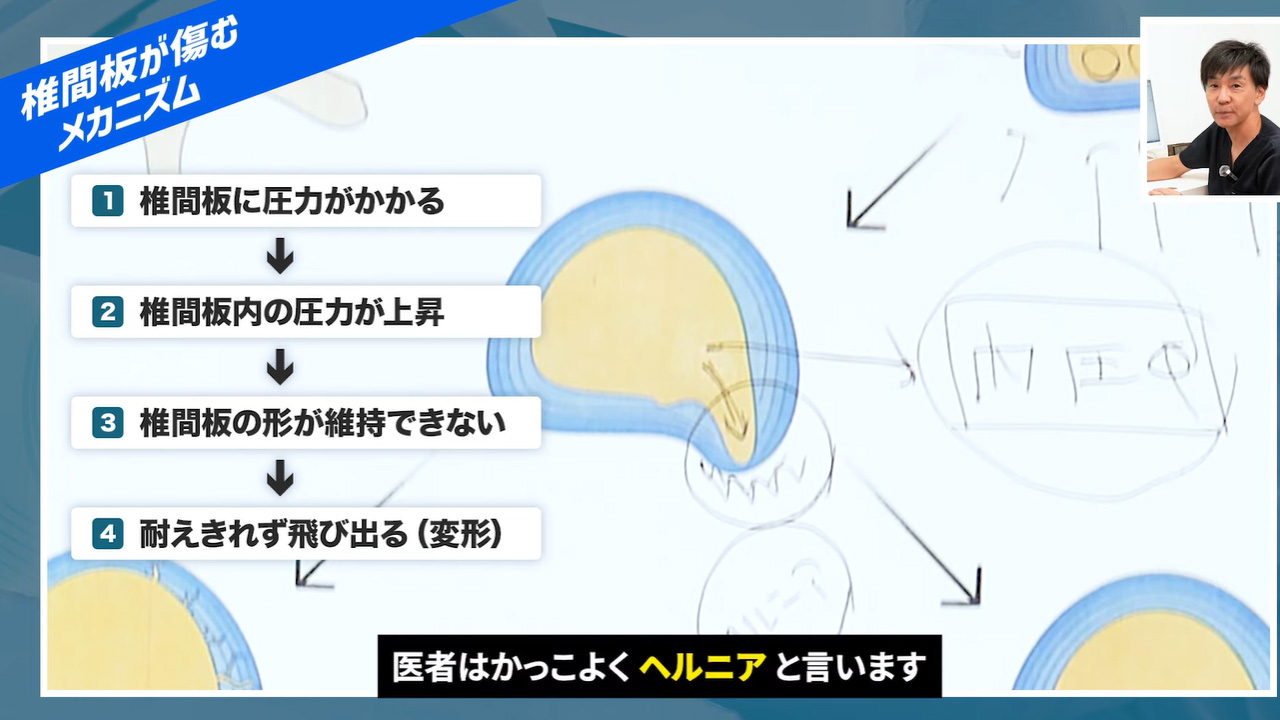 内圧が上がって飛び出した椎間板