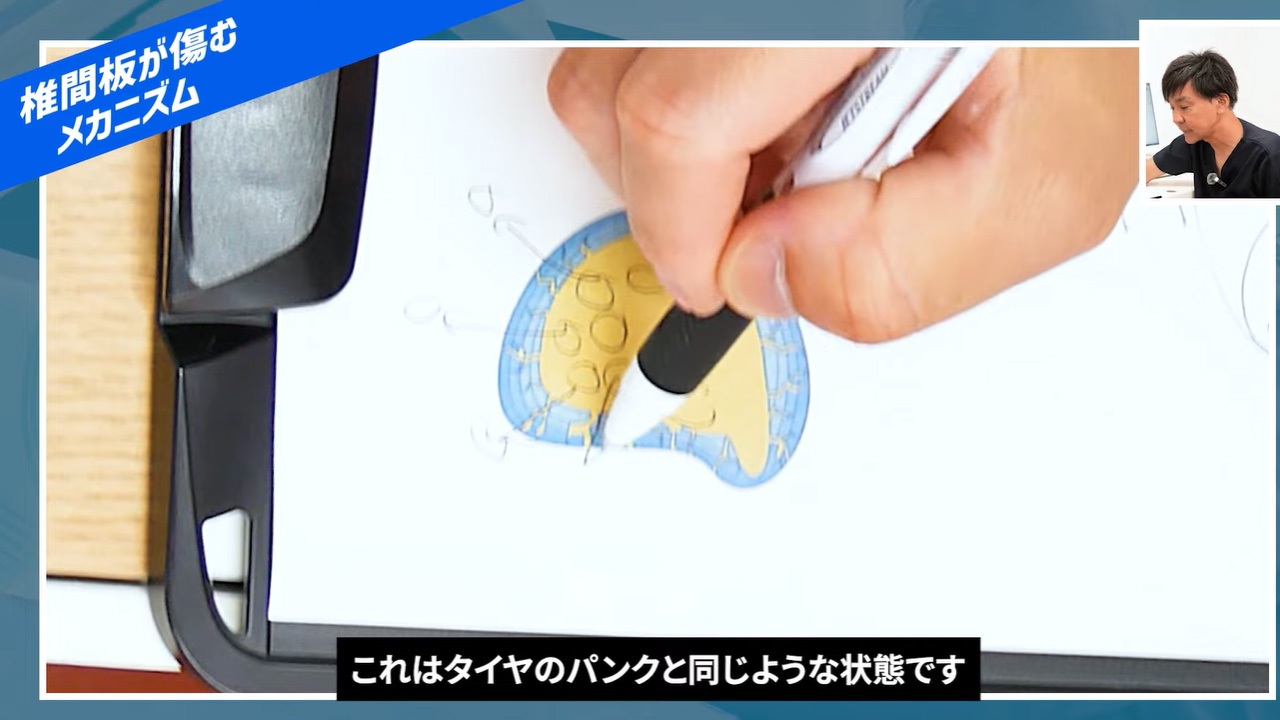 パンクした椎間板