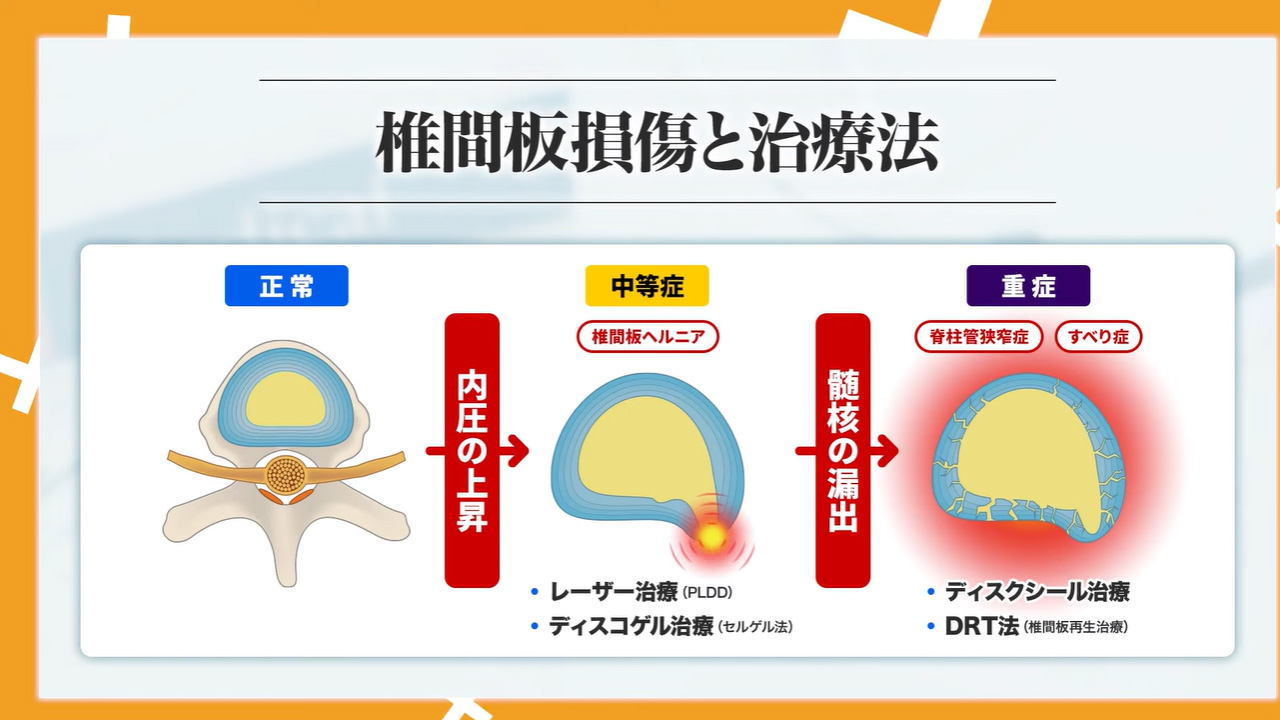 椎間板損傷と治療法
