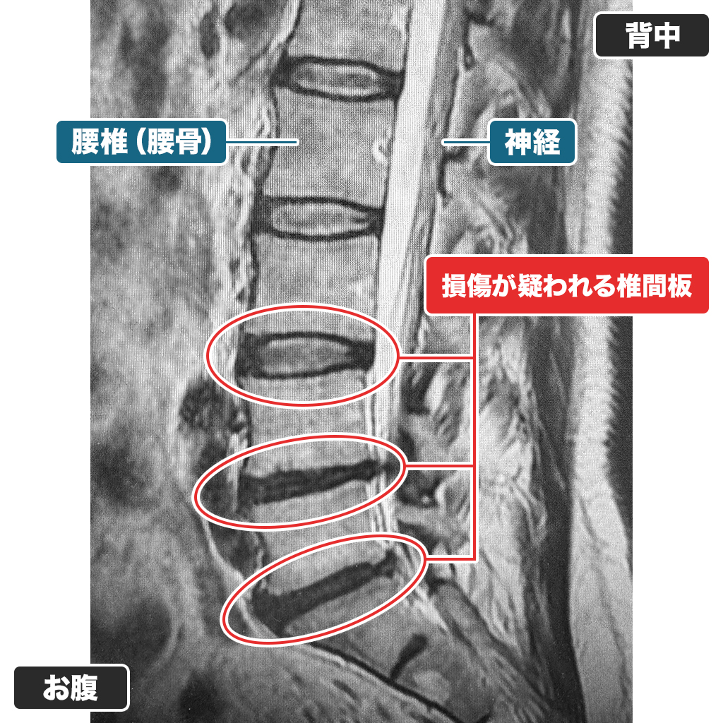 MRI