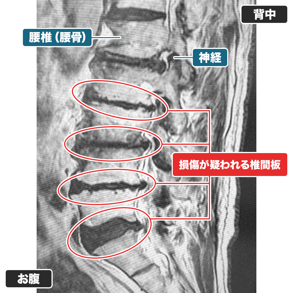 MRI