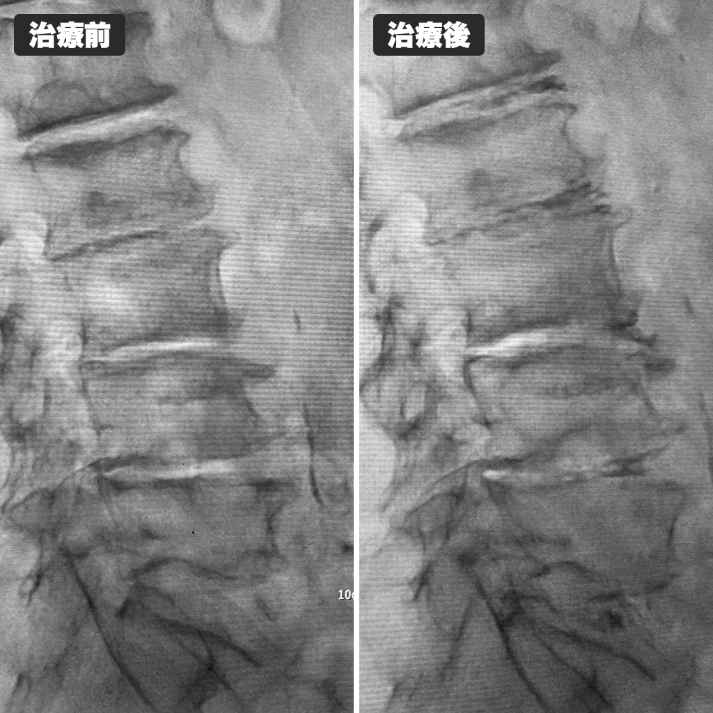 治療前後のレントゲン写真