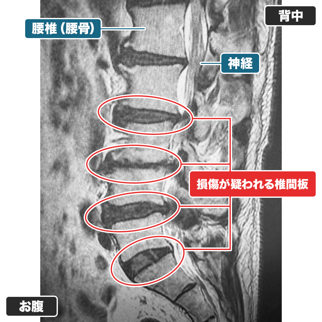 MRI