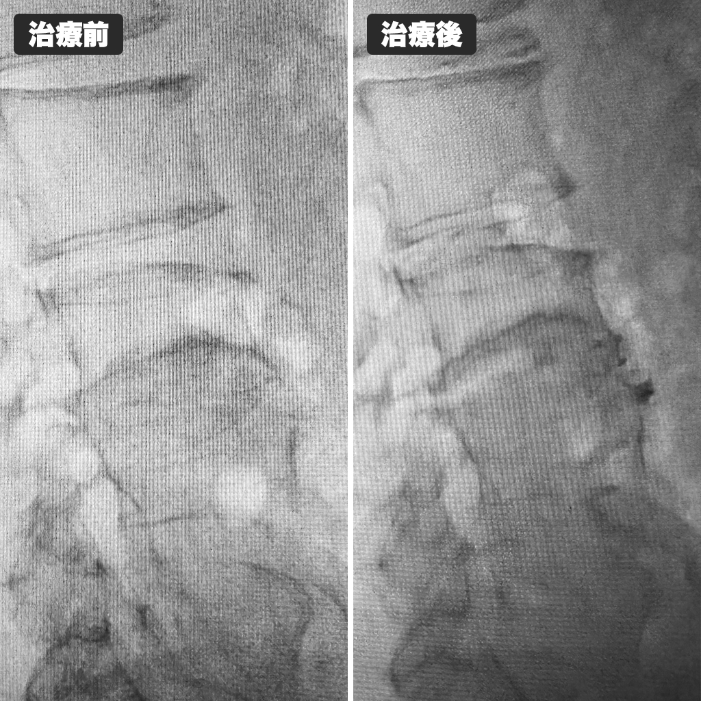 治療前後のレントゲン写真