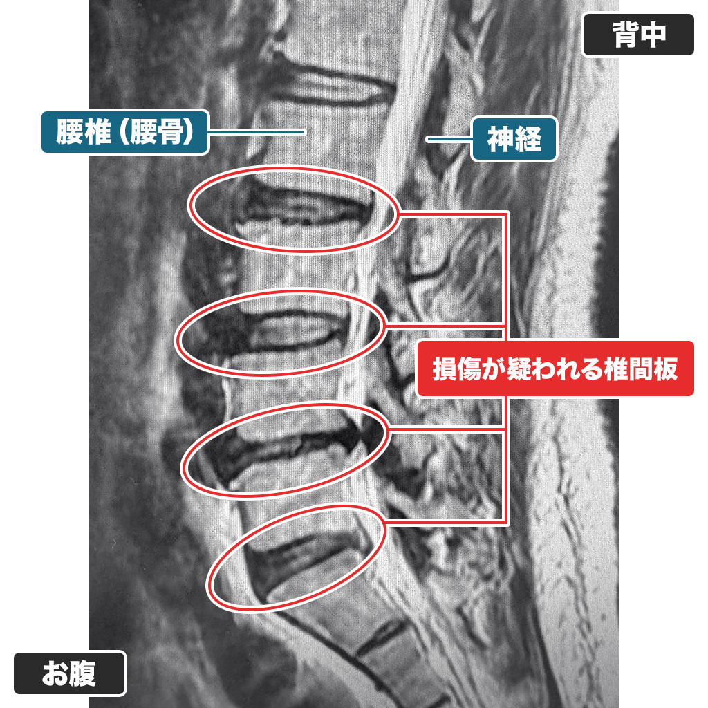 MRI