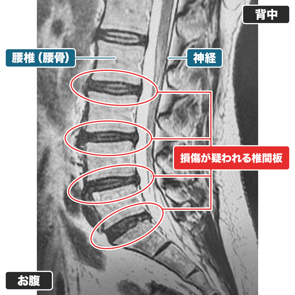 MRI