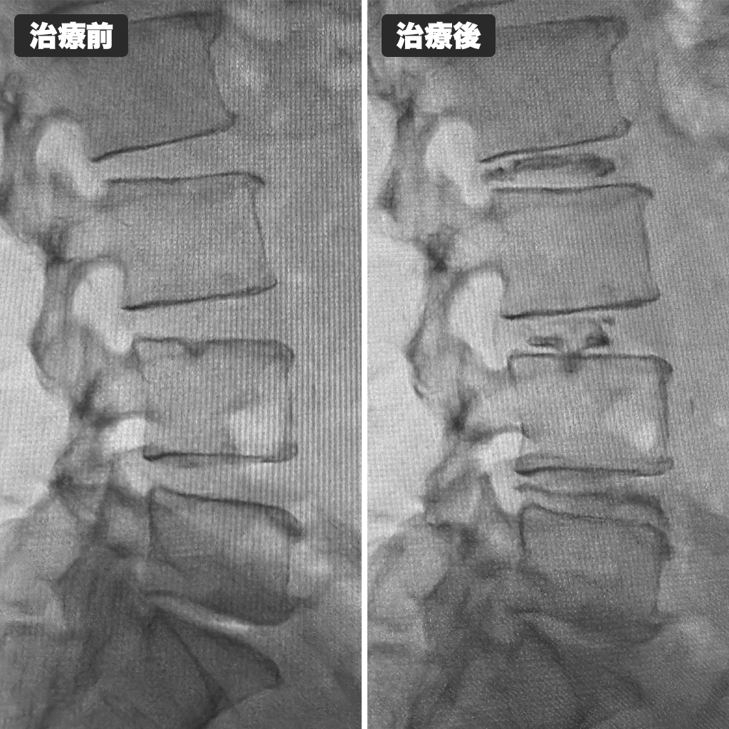 治療前後のレントゲン写真