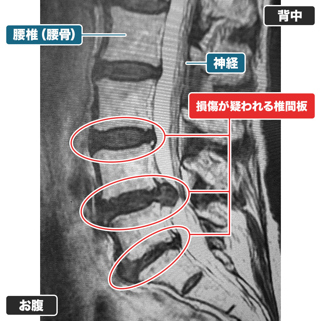 MRI