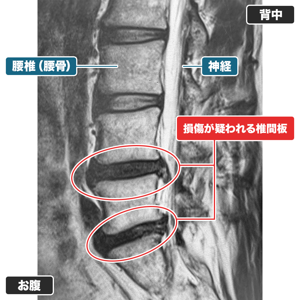 治療前のMRI