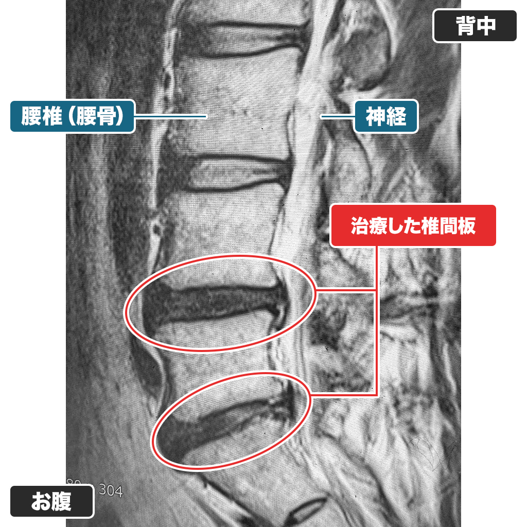 治療後のMRI