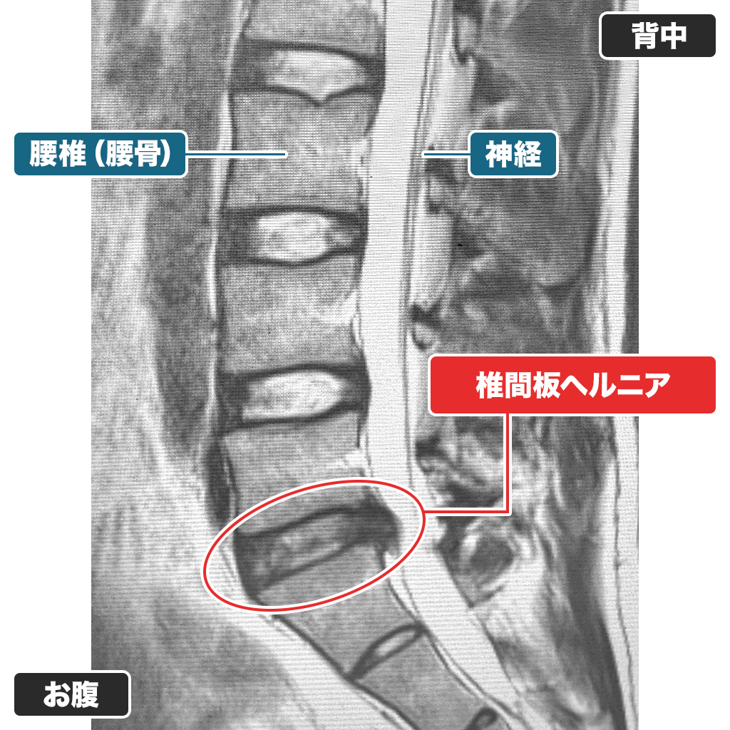 MRI