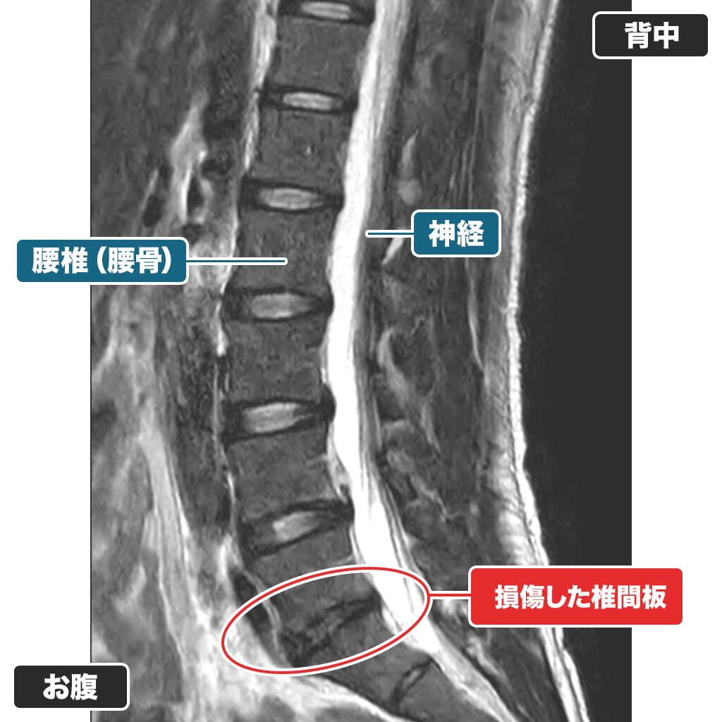 30代の椎間板変性症