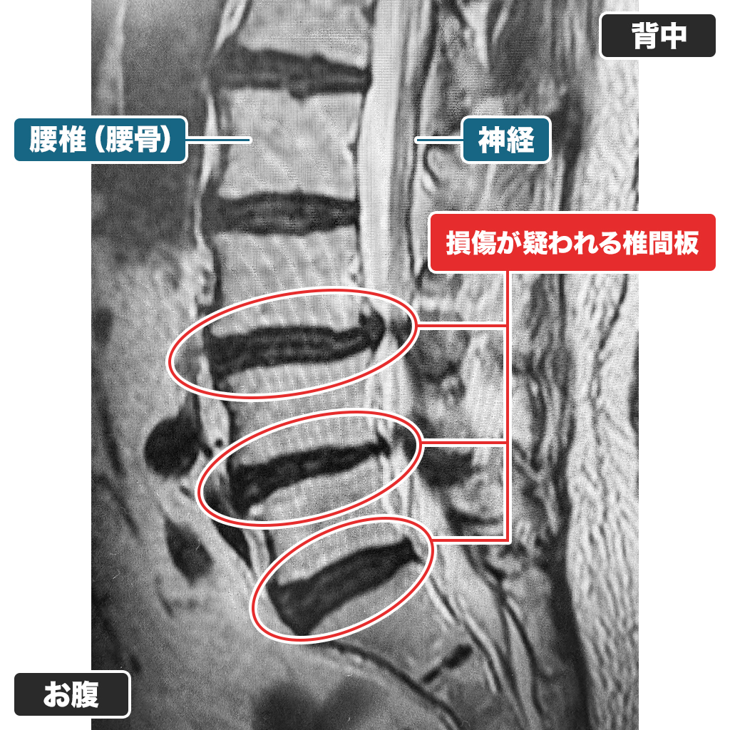 MRI