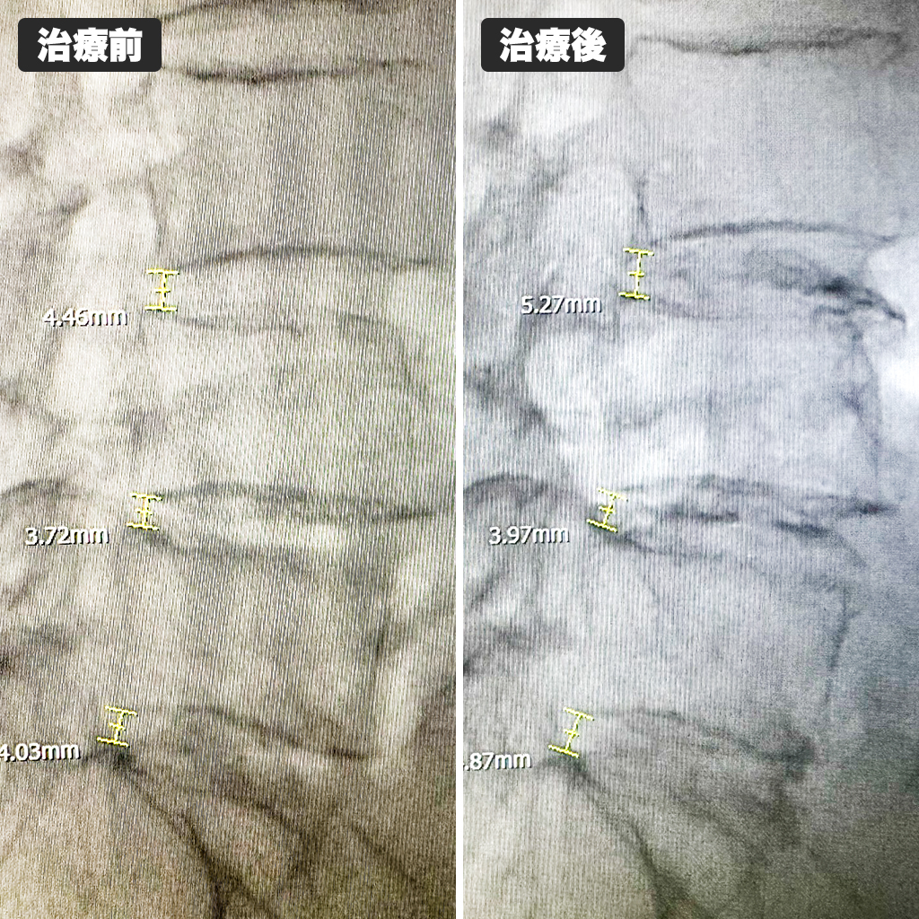治療前後のレントゲン