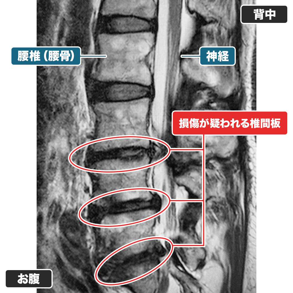 MRI