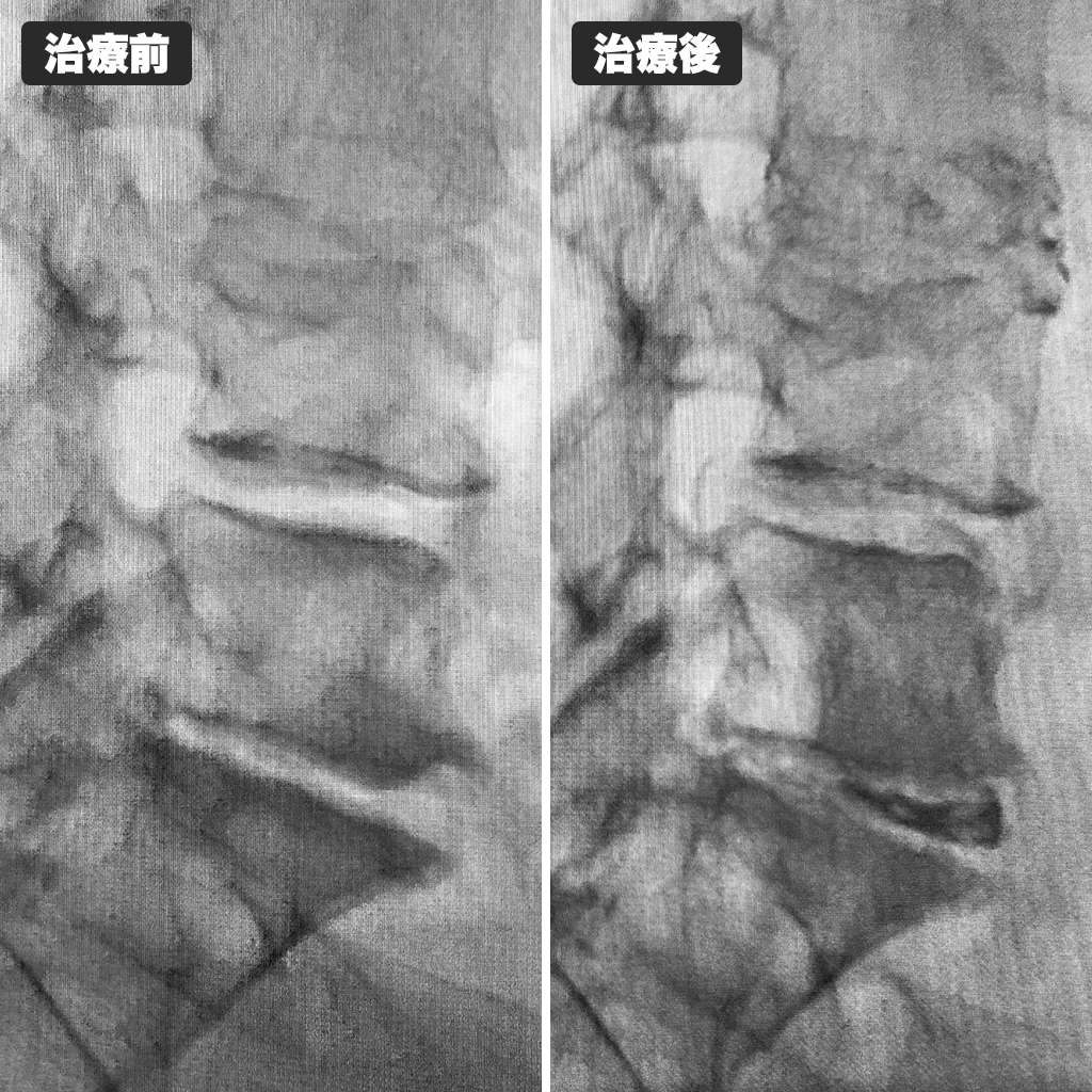 治療前後のレントゲン