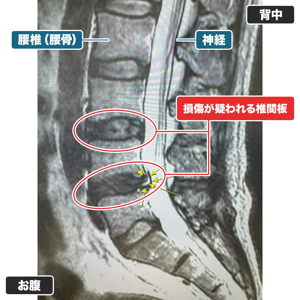 MRI