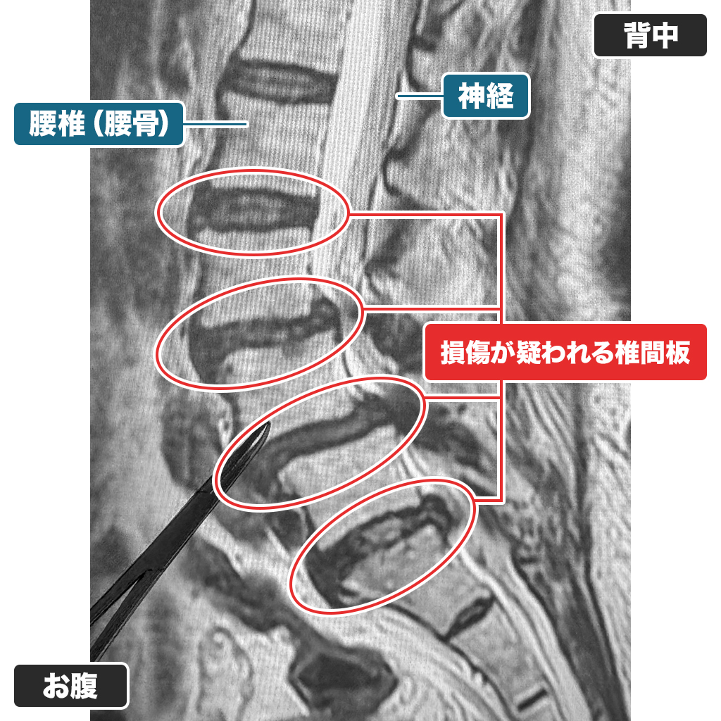MRI