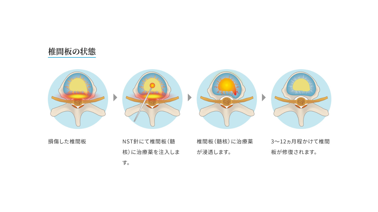 DRT法の説明