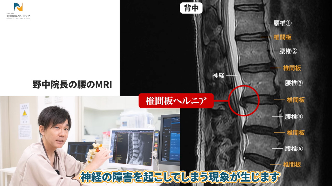 MRI画像