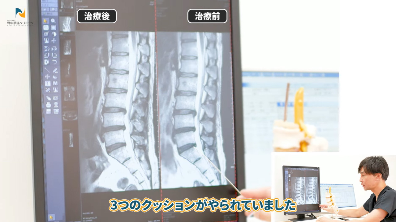 椎間板3カ所の損傷