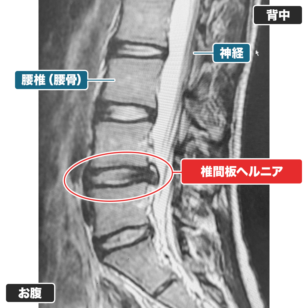 治療前のMRI検査