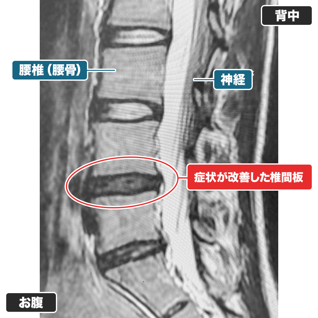 治療後本日のMRI検査