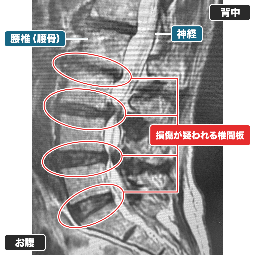 MRI