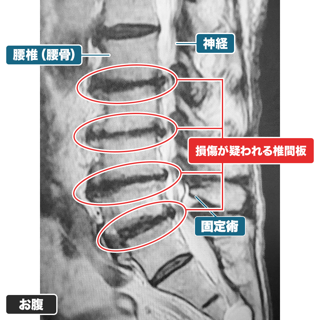 MRI