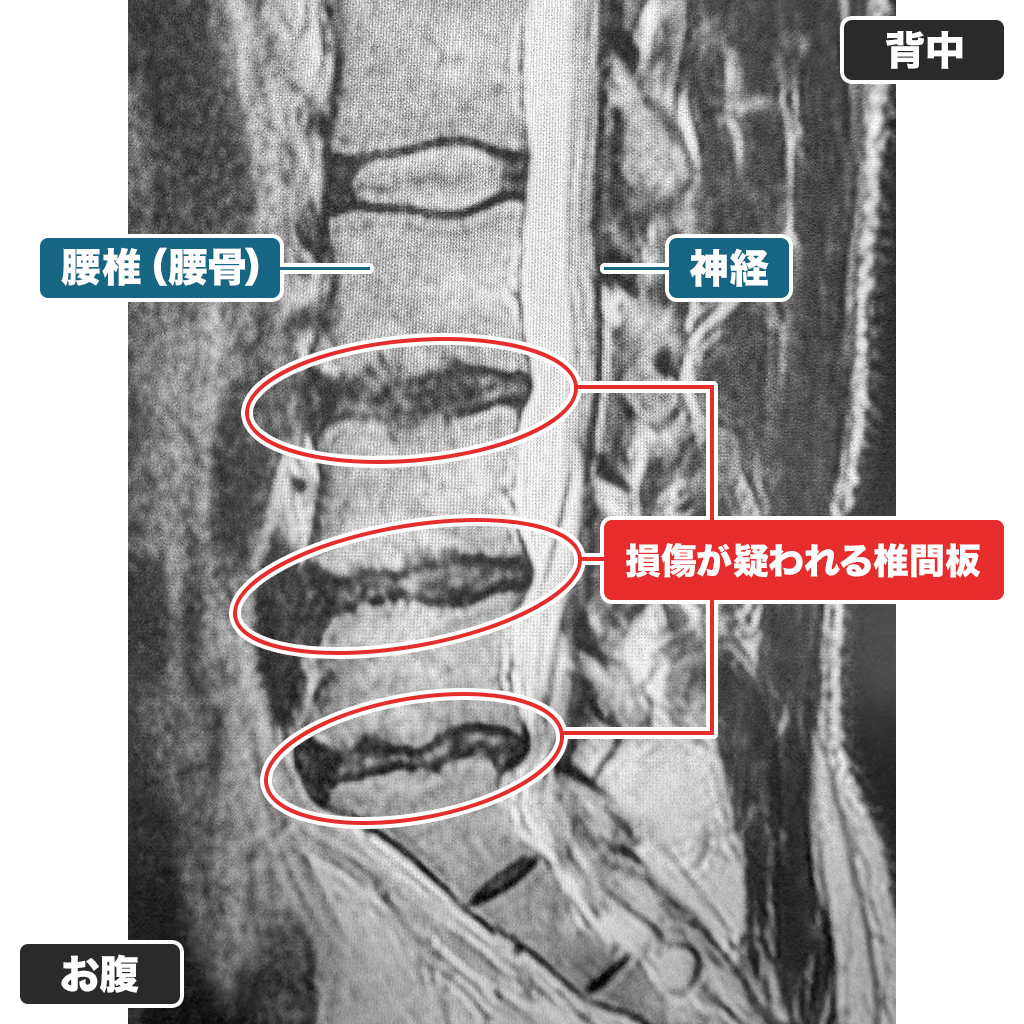 MRI