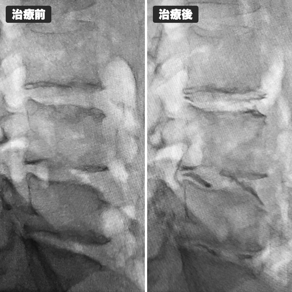 治療前後のレントゲン