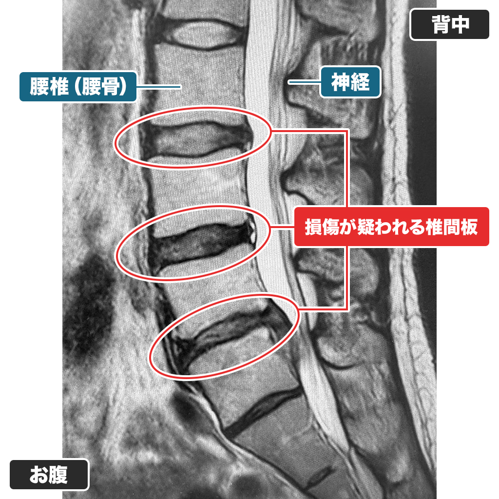 MRI