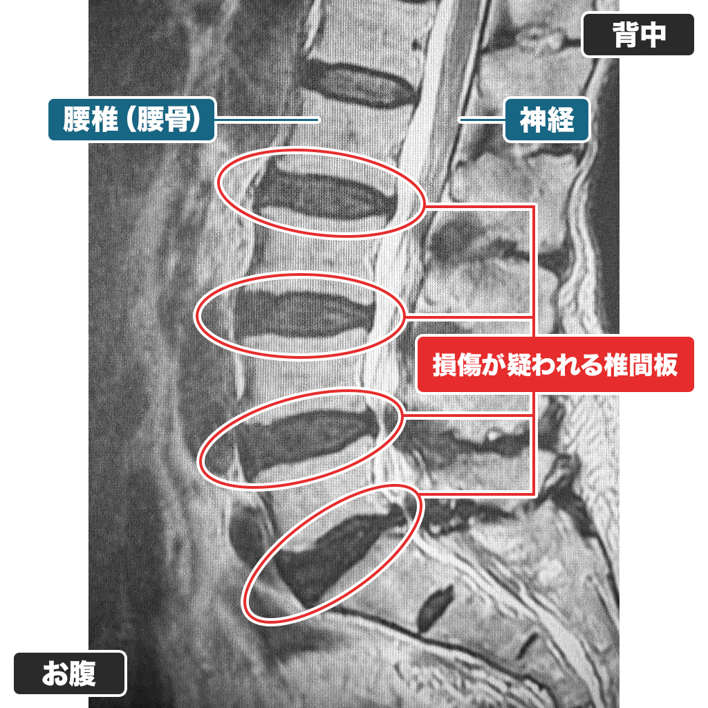 MRI