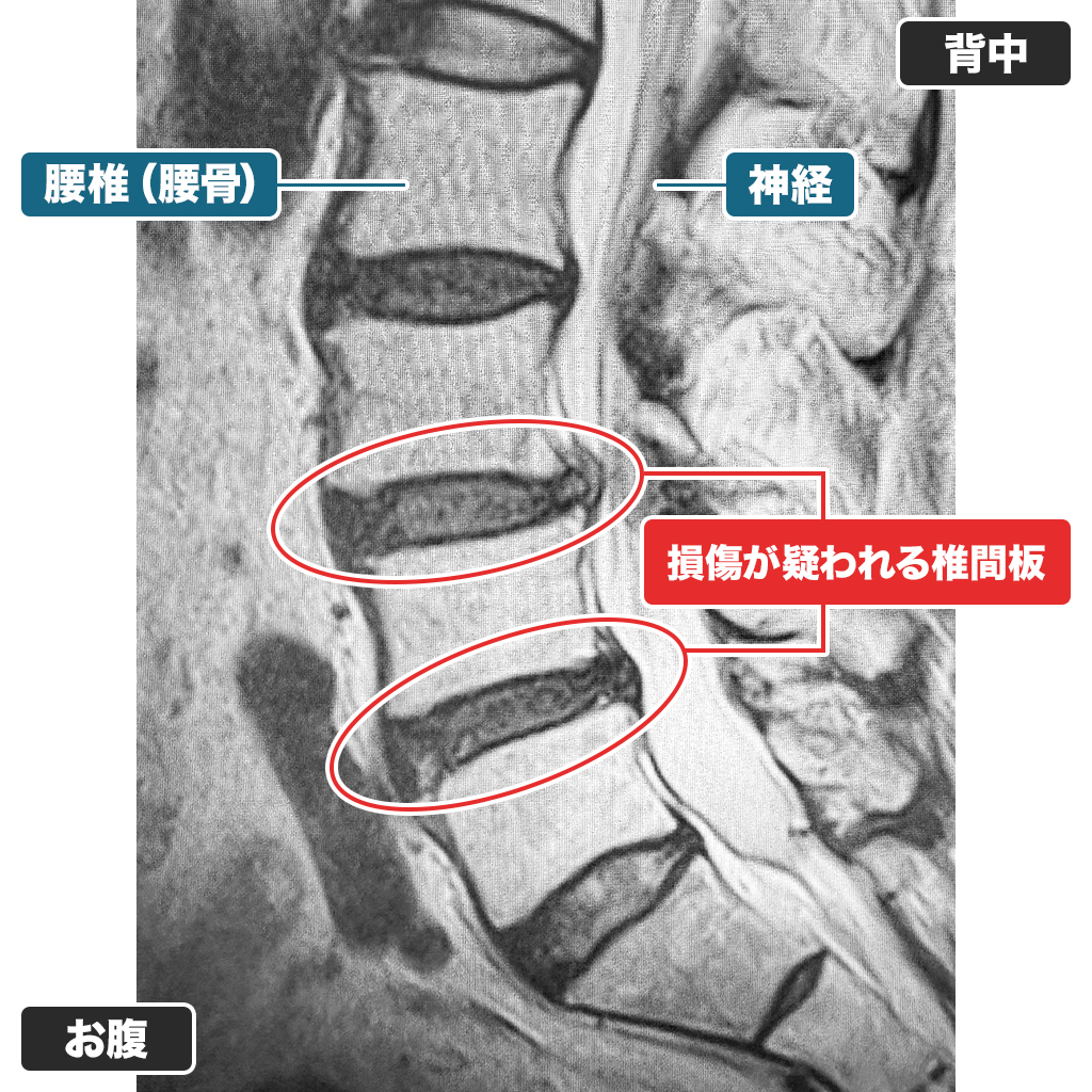 MRI