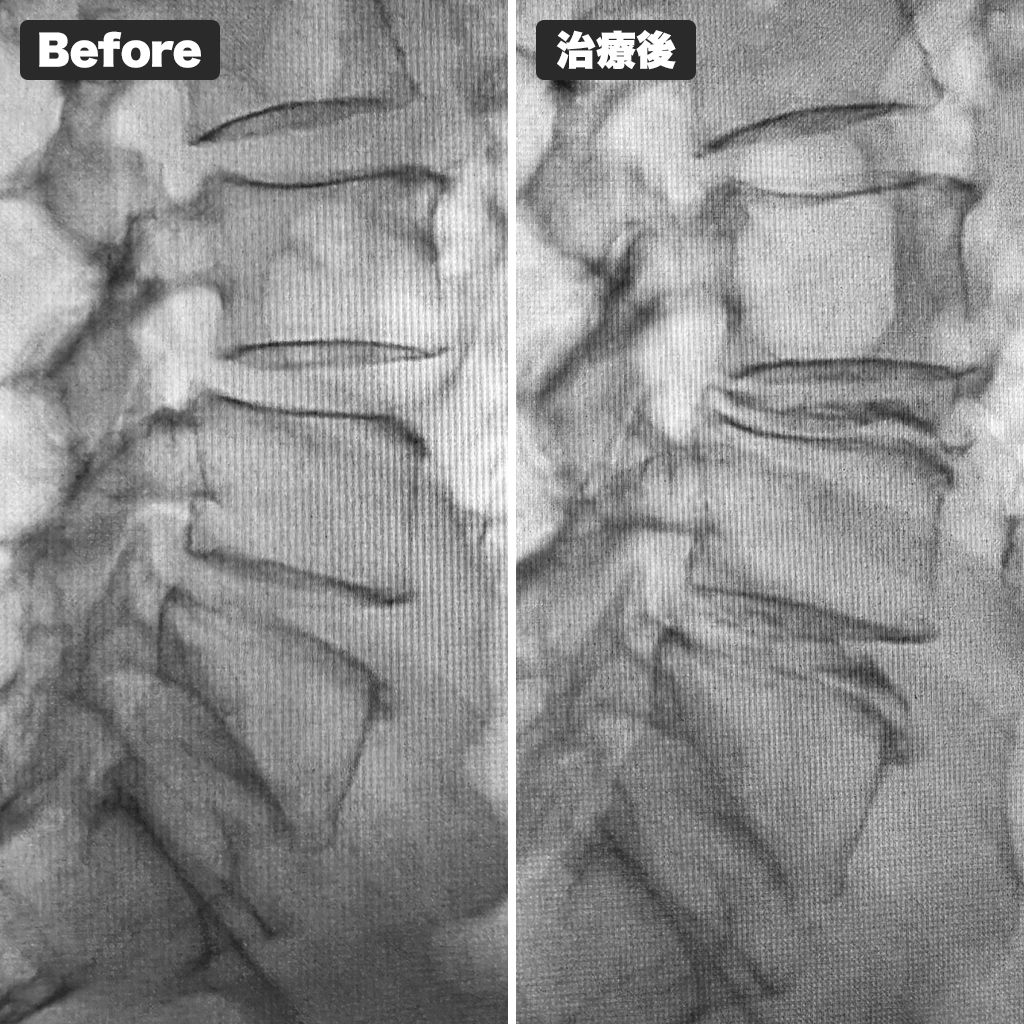 治療前後のレントゲン