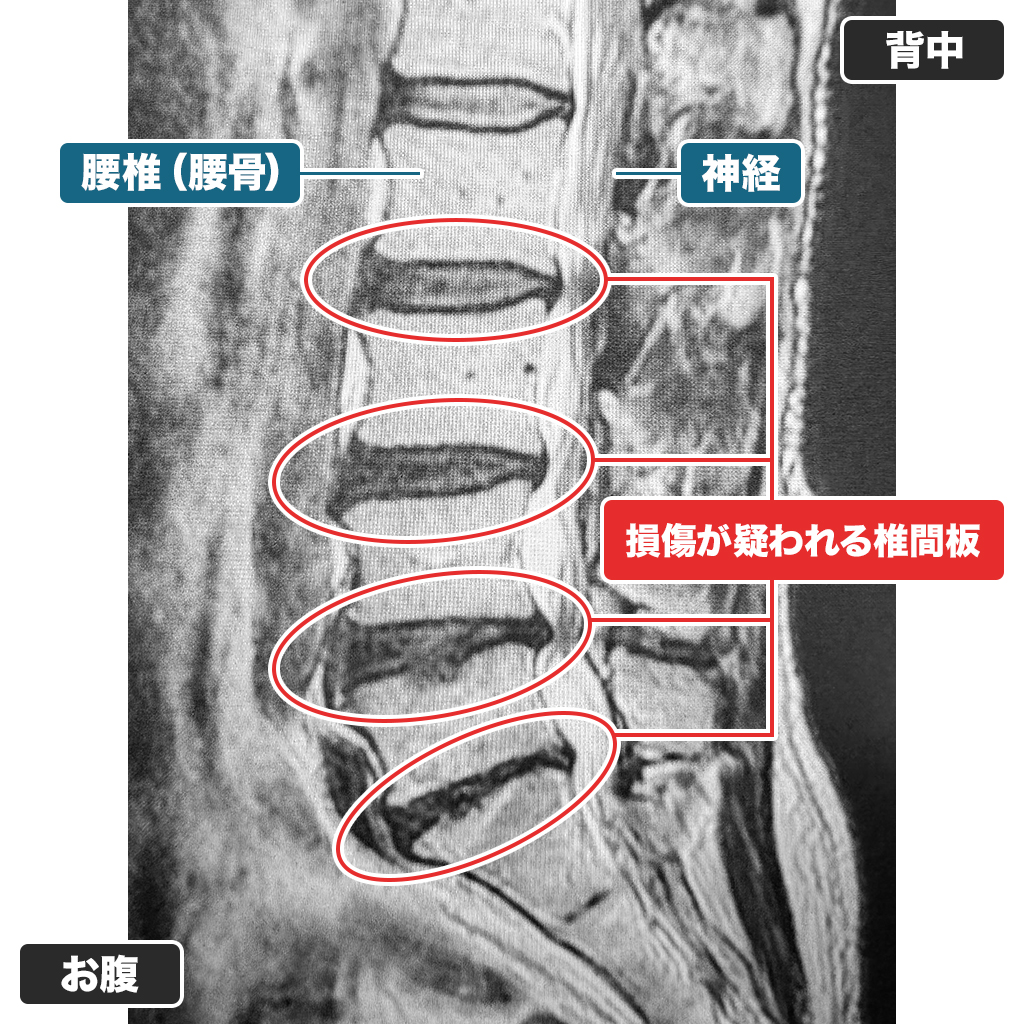 MRI