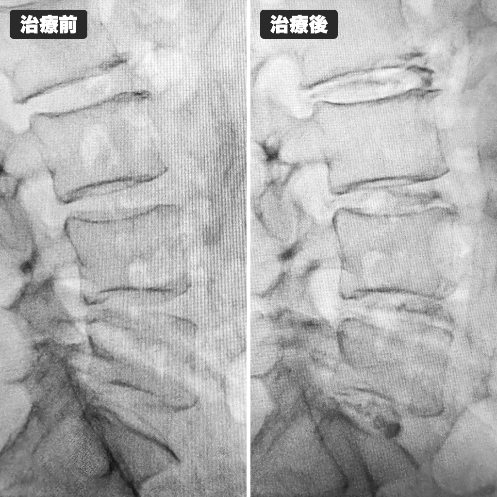 治療前後のレントゲン