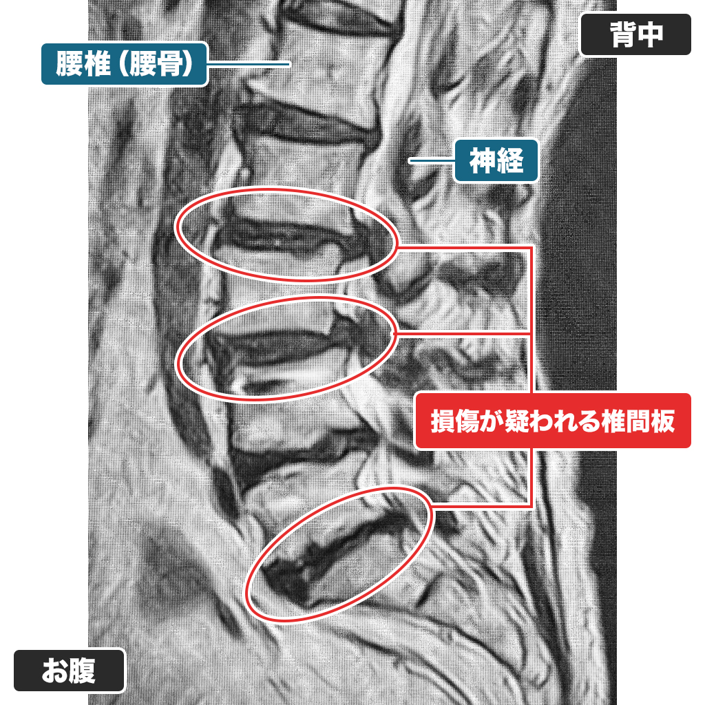 MRI
