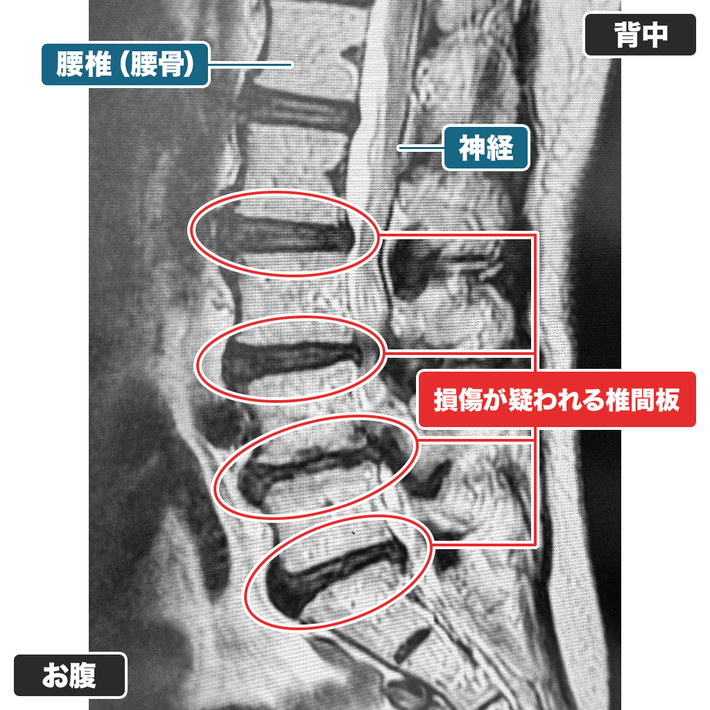 MRI