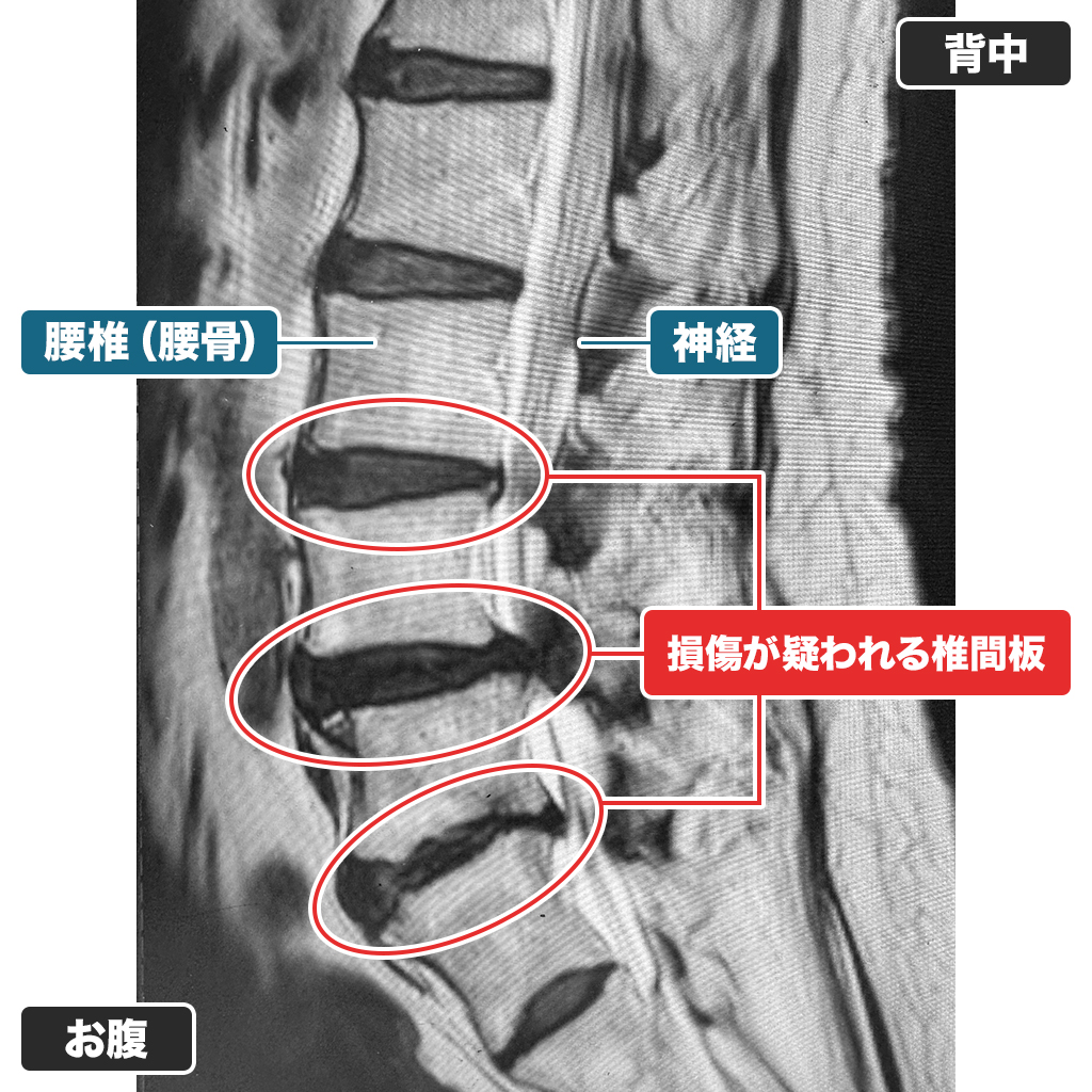 治療前のMRI検査