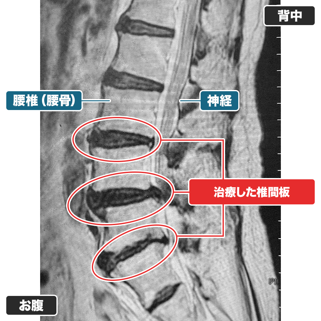 治療後6ヵ月経過したMRI検査